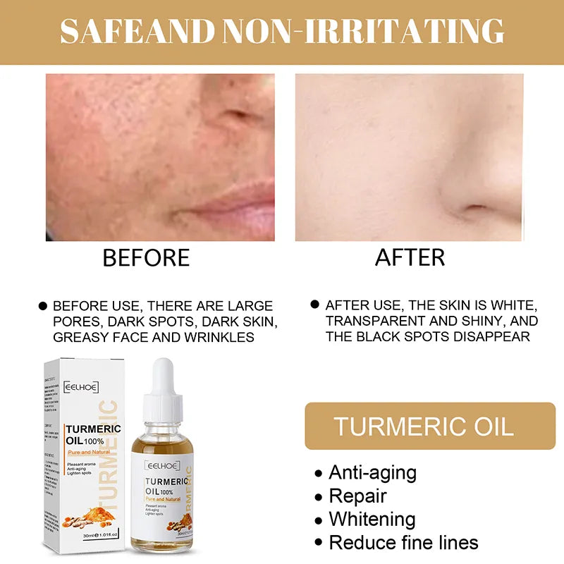 30ml Turmeric Oil Skin To Lightening Acne
